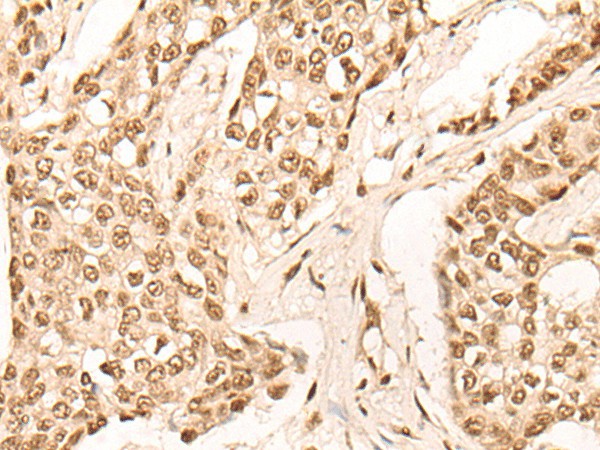 Immunohistochemistry of paraffin-embedded Human breast cancer tissue  using EIF4A3 Polyclonal Antibody at dilution of 1:45(?200)