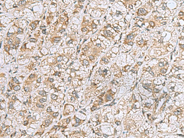 Immunohistochemistry of paraffin-embedded Human liver cancer tissue  using CCDC134 Polyclonal Antibody at dilution of 1:50(?200)