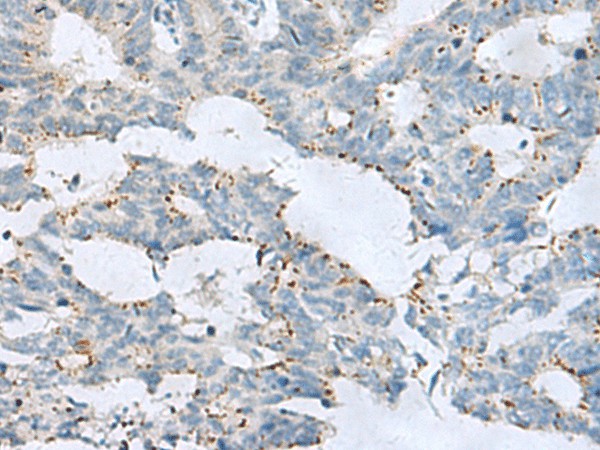 Immunohistochemistry of paraffin-embedded Human colorectal cancer tissue  using GPR6  Polyclonal Antibody at dilution of 1:80(?200)