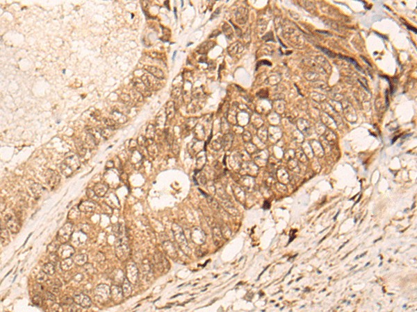 Immunohistochemistry of paraffin-embedded Human colorectal cancer tissue  using HIPK3 Polyclonal Antibody at dilution of 1:60(?200)