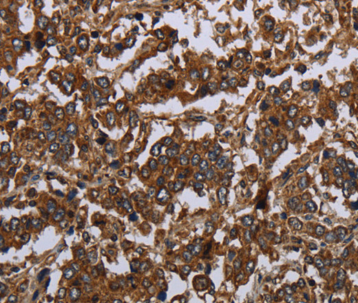 Immunohistochemistry of paraffin-embedded Human liver cancer tissue using HOMER2 Polyclonal Antibody at dilution 1:30