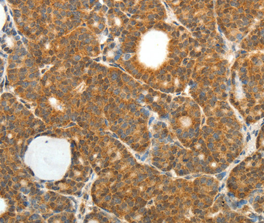 Immunohistochemistry of paraffin-embedded Human thyroid cancer using PRDX3 Polyclonal Antibody at dilution of 1:50