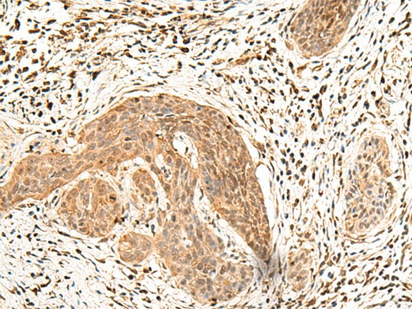 Immunohistochemistry of paraffin-embedded Human esophagus cancer tissue  using LDHA Polyclonal Antibody at dilution of 1:25(?200)