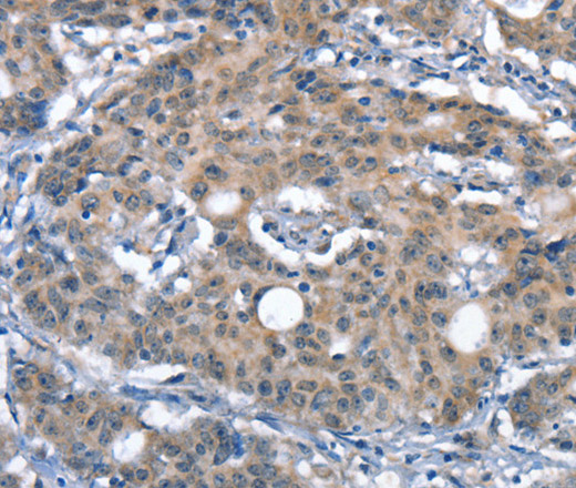 Immunohistochemistry of paraffin-embedded Human gastric cancer tissue using CD226 Polyclonal Antibody at dilution 1:60