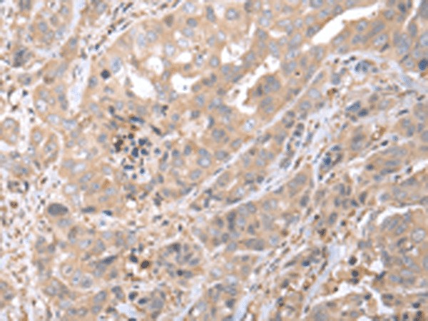 Immunohistochemistry of paraffin-embedded Human breast cancer tissue  using PPBP Polyclonal Antibody at dilution of 1:35(?200)