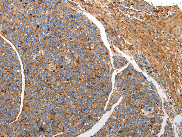 Immunohistochemistry of paraffin-embedded Human liver cancer tissue using CD151 Polyclonal Antibody at dilution 1:25