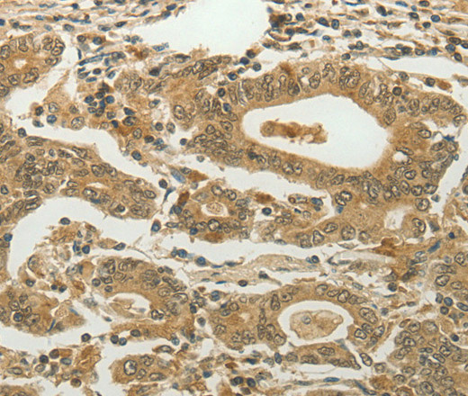 Immunohistochemistry of paraffin-embedded Human gastric cancer using MYSM1 Polyclonal Antibody at dilution of 1:60