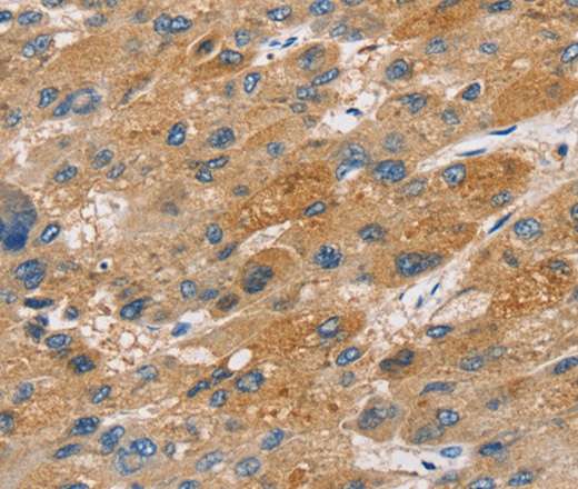 Immunohistochemistry of paraffin-embedded Human liver cancer tissue using ST18 Polyclonal Antibody at dilution 1:50