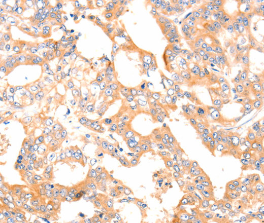 Immunohistochemistry of paraffin-embedded Human gastric cancer tissue using Factor XIIIa Polyclonal Antibody at dilution 1:80