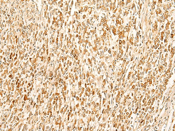 Immunohistochemistry of paraffin-embedded Human gastric cancer tissue  using SMUG1 Polyclonal Antibody at dilution of 1:50(?200)