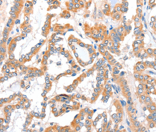 Immunohistochemistry of paraffin-embedded Human thyroid cancer tissue using ACSBG1 Polyclonal Antibody at dilution 1:40