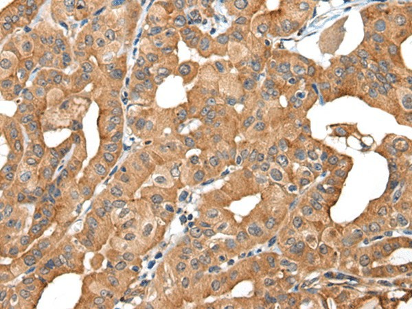 Immunohistochemistry of paraffin-embedded Human thyroid cancer tissue  using INF2 Polyclonal Antibody at dilution of 1:40(?200)