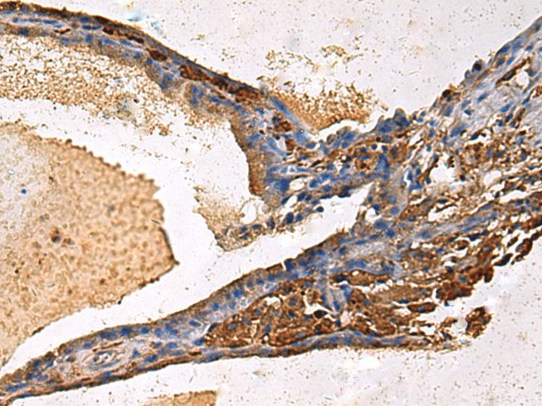 Immunohistochemistry of paraffin-embedded Human thyroid cancer tissue  using LYAR Polyclonal Antibody at dilution of 1:60(?200)