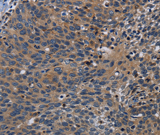 Immunohistochemistry of paraffin-embedded Human cervical cancer tissue using PCDHB15 Polyclonal Antibody at dilution 1:50