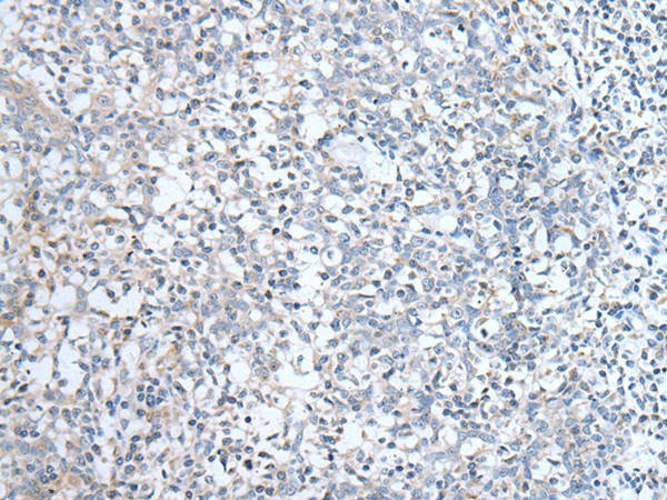 Immunohistochemistry of paraffin-embedded Human tonsil tissue  using ABCD1 Polyclonal Antibody at dilution of 1:80(?200)