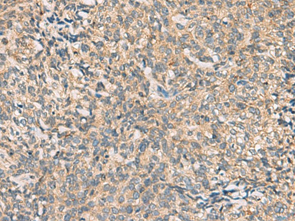 Immunohistochemistry of paraffin-embedded Human cervical cancer tissue  using CMTM4 Polyclonal Antibody at dilution of 1:55(?200)