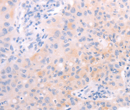 Immunohistochemistry of paraffin-embedded Human lung cancer tissue using AMH Polyclonal Antibody at dilution 1:30