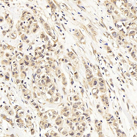 Immunohistochemistry analysis of paraffin-embedded human breast cancer  using ATF2 Polyclonal Antibody at dilution of 1:400.