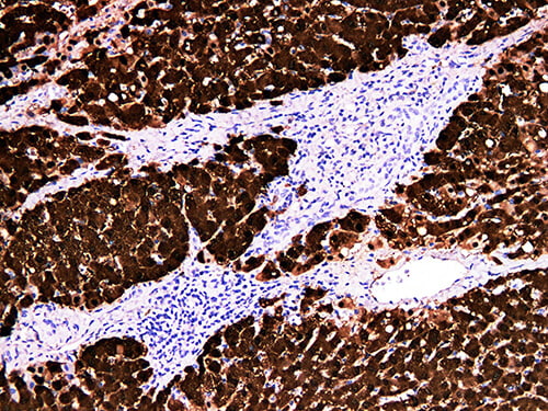 Immunohistochemistry of paraffinembedded Human liver cancer tissue with Arginase-1 Monoclonal Antibody(Antigen repaired by EDTA).