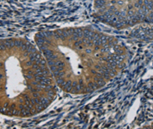 Immunohistochemistry of paraffin-embedded Human cervical cancer using CTGF Polyclonal Antibody at dilution of 1:50