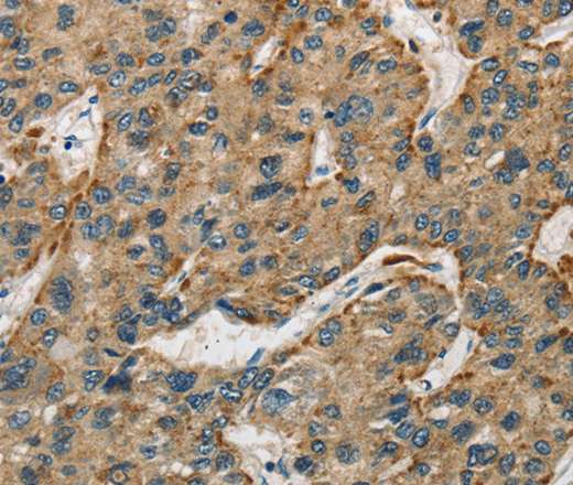 Immunohistochemistry of paraffin-embedded Human liver cancer using Cathepsin E Polyclonal Antibody at dilution of 1:50