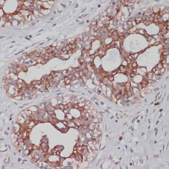Immunohistochemistry of paraffin-embedded Human mammary cancer using TPD52 Polyclonal Antibody at dilution of 1:100 (40x lens).