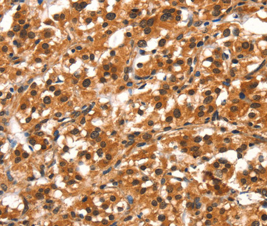 Immunohistochemistry of paraffin-embedded Human thyroid cancer tissue using DDX4 Polyclonal Antibody at dilution 1:40