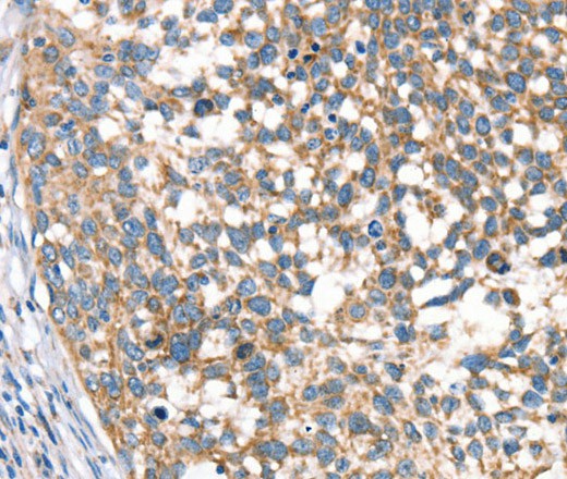 Immunohistochemistry of paraffin-embedded Human cervical cancer using DECR1 Polyclonal Antibody at dilution of 1:40