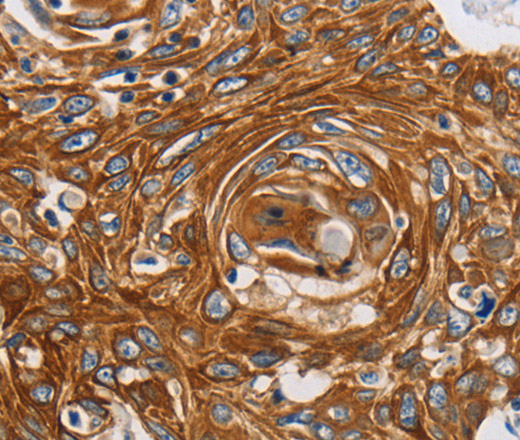 Immunohistochemistry of paraffin-embedded Human esophagus cancer tissue using GRIN1 Polyclonal Antibody at dilution 1:45