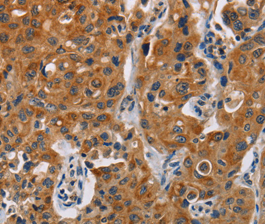 Immunohistochemistry of paraffin-embedded Human lung cancer tissue using CK-13 Polyclonal Antibody at dilution 1:50