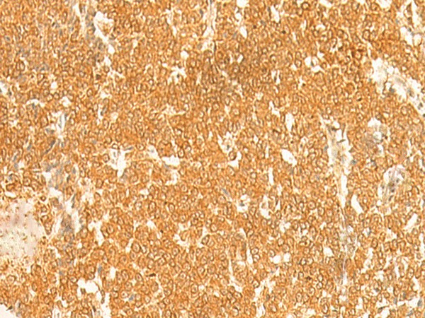 Immunohistochemistry of paraffin-embedded Human ovarian cancer tissue  using KRT76 Polyclonal Antibody at dilution of 1:30(?200)