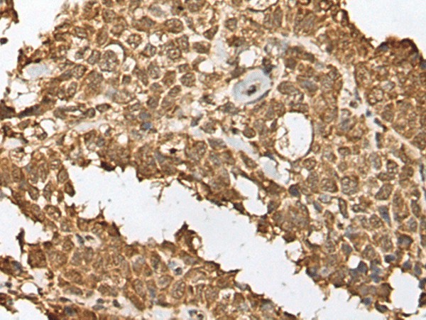 Immunohistochemistry of paraffin-embedded Human ovarian cancer tissue  using RBL2 Polyclonal Antibody at dilution of 1:45(?200)