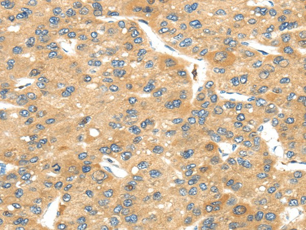 Immunohistochemistry of paraffin-embedded Human liver cancer tissue using UBTD2 Polyclonal Antibody at dilution 1:40