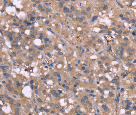 Immunohistochemistry of paraffin-embedded Human thyroid cancer tissue using HP Polyclonal Antibody at dilution 1:50