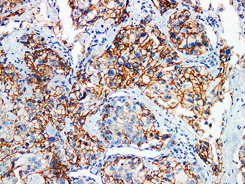 Immunohistochemistry of paraffinembedded Human breast cancer tissue with p120 Monoclonal Antibody(Antigen repaired by EDTA).