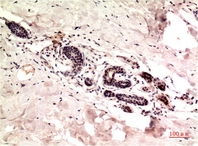 Immunohistochemistry of paraffin-embedded Human breast carcinoma tissue using gamma Tubulin Monoclonal Antibody at dilution of 1:200.