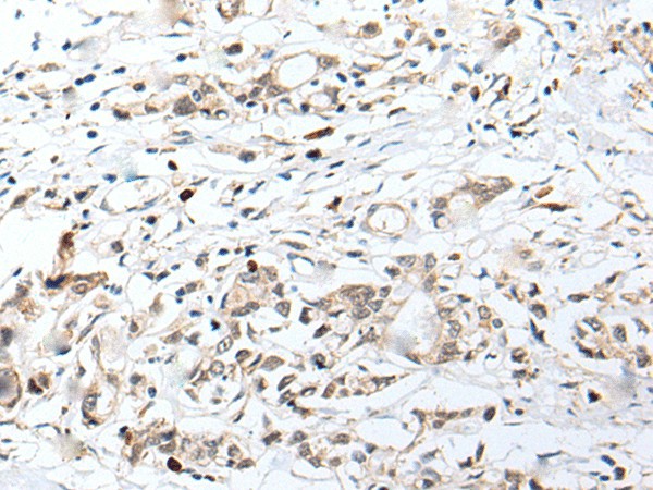 Immunohistochemistry of paraffin-embedded Human gastric cancer tissue  using CHRNA5 Polyclonal Antibody at dilution of 1:50(?200)