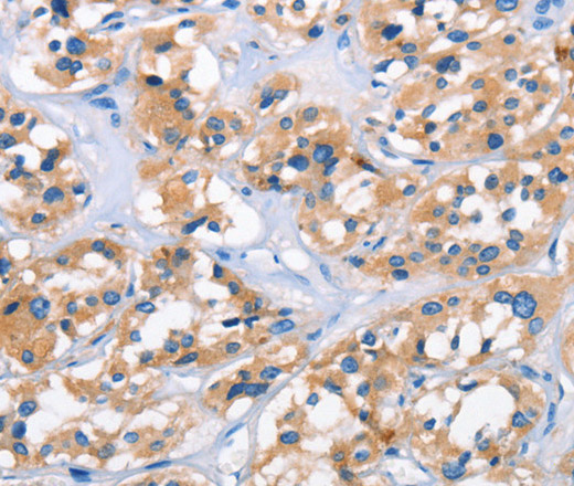 Immunohistochemistry of paraffin-embedded Human thyroid cancer tissue using APOL6 Polyclonal Antibody at dilution 1:50