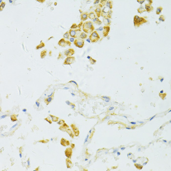 Immunohistochemistry of paraffin-embedded Human lung cancer using SIRT2 Polyclonal Antibody at dilution of  1:100 (40x lens).