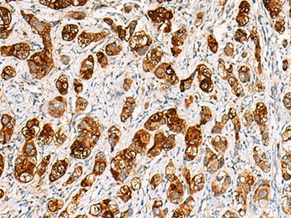 Immunohistochemistry of paraffin-embedded Human liver cancer tissue  using SAA1 Polyclonal Antibody at dilution of 1:70(?200)