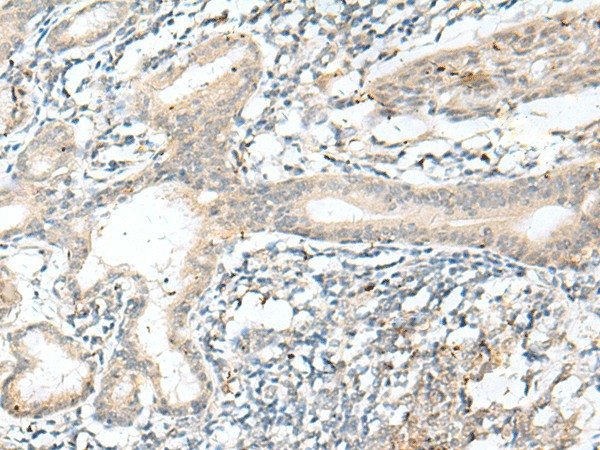 Immunohistochemistry of paraffin-embedded Human esophagus cancer tissue  using NXNL1 Polyclonal Antibody at dilution of 1:45(?200)