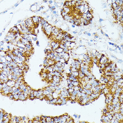 Immunohistochemistry of paraffin-embedded Human colon carcinoma using TRAP1 Polyclonal Antibody at dilution of  1:100 (40x lens).