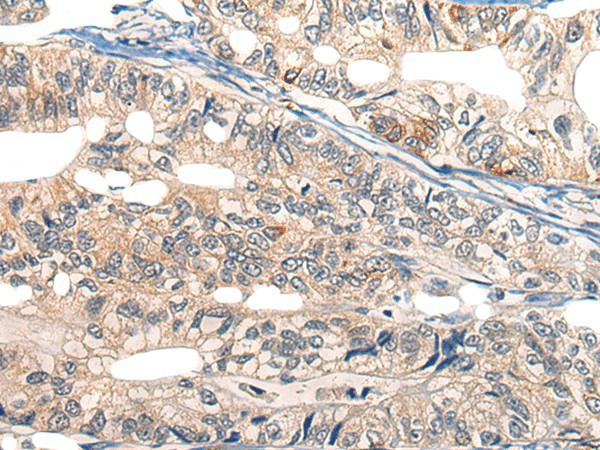 Immunohistochemistry of paraffin-embedded Human gastric cancer tissue  using EPHA6 Polyclonal Antibody at dilution of 1:25(?200)