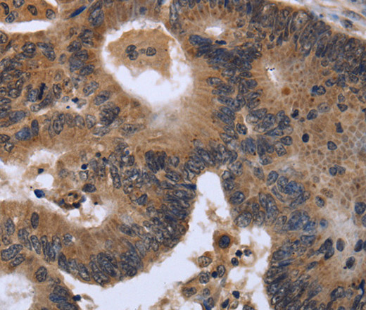 Immunohistochemistry of paraffin-embedded Human colon cancer tissue using FGF21 Polyclonal Antibody at dilution of 1:40