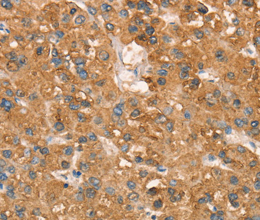 Immunohistochemistry of paraffin-embedded Human liver cancer using CD297 Polyclonal Antibody at dilution of 1:50