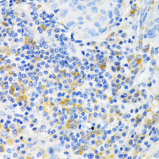 Immunohistochemistry of paraffin-embedded Human lung cancer using PAK1 Polyclonal Antibody at dilution of 1:100 (40x lens).