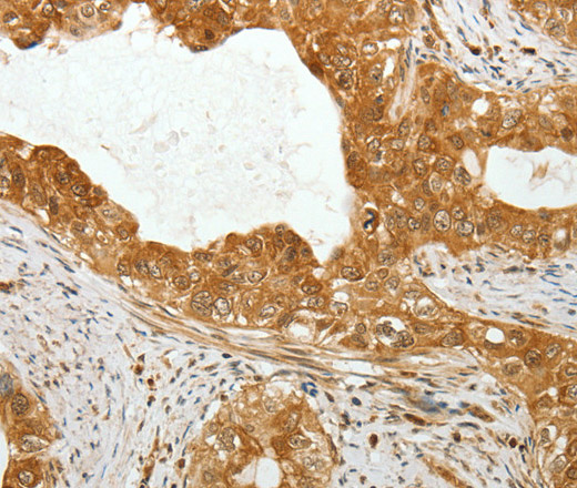 Immunohistochemistry of paraffin-embedded Human cervical cancer using TEKT1 Polyclonal Antibody at dilution of 1:30