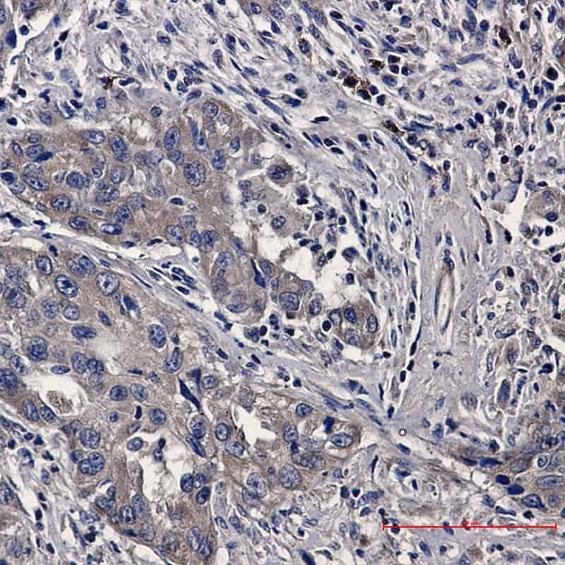 Immunohistochemistry of Bax in paraffin-embedded Human lung cancer tissue using Bax Rabbit mAb at dilution 1:20