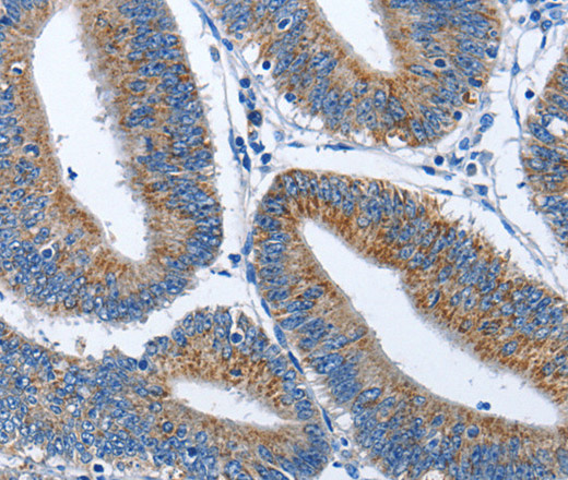 Immunohistochemistry of paraffin-embedded Human colon cancer tissue using CADM3 Polyclonal Antibody at dilution 1:40