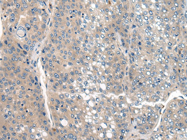 Immunohistochemistry of paraffin-embedded Human liver cancer tissue  using CLTCL1 Polyclonal Antibody at dilution of 1:60(?200)